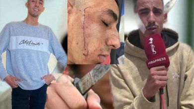 الشاب “نزار ” ضحية “التشرميل “.. من حياة هادئة إلى معاناة مستمرة (فيديو)